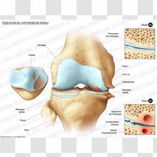 osteoporosis bone density osteopenia disease bones transparent png osteoporosis bone density osteopenia